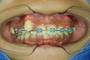 braces for crowding teeth