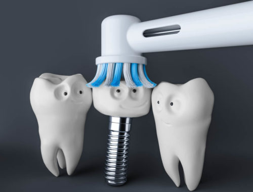 dental implants pros and cons for patients