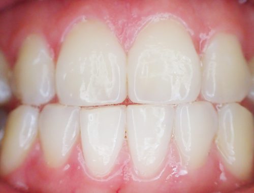how much does pinhole gum surgery cost