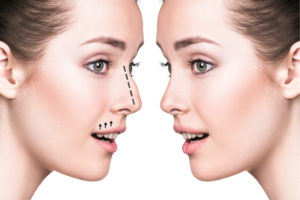 How long does it take to recover from rhinoplasty surgery?