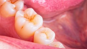 disadvantages of deep cleaning teeth tartar and plaque